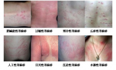 重庆引起荨麻疹的原因